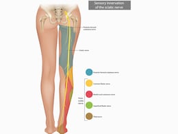 How To Manage And Prevent Painful Sciatica? Nutritionist Explains