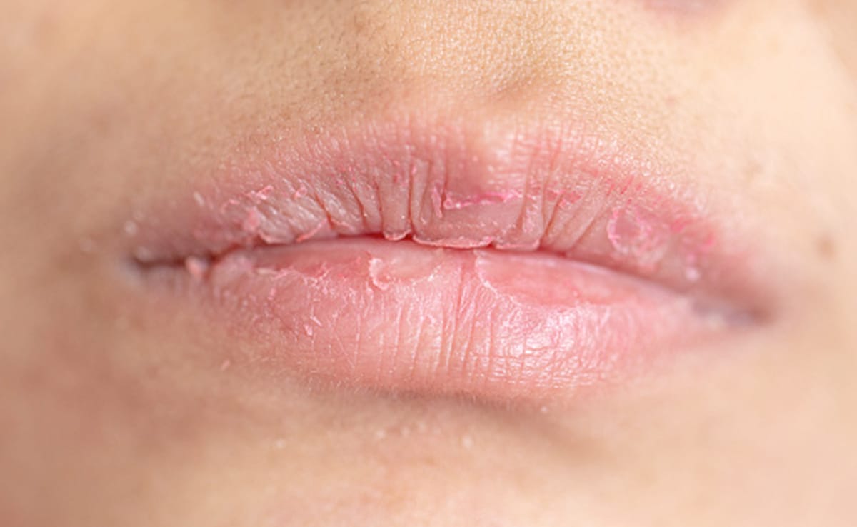 Dry Lips Chapped Lips Remedies How To Get Rid Of Chapped Lips Hothon Ko Fatne Se Kaise Bachaye