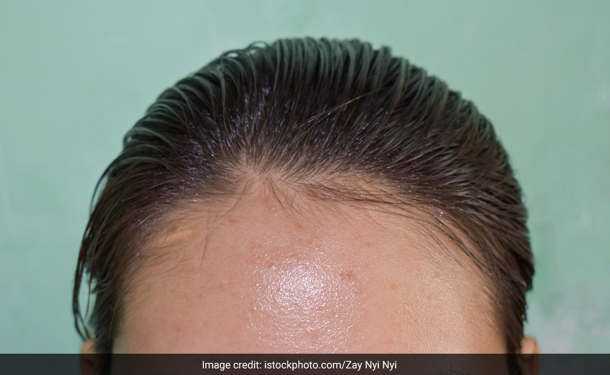 धोने के दूसरे दिन ही चिपचिपे हो जाते हैं बाल तो इन 5 बातों को जान लीजिए तुरंत, ऑयली नहीं दिखेंगे Hair 