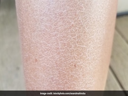 खुरचने पर सफेद दिखने लगती है त्वचा तो क्रीम नहीं बल्कि इस चीज को लगाना कर दीजिए शुरू, टिकी रहेगी नमी  खुरचने पर सफेद दिखने लगती है त्वचा तो क्रीम नहीं बल्कि इस चीज को लगाना कर दीजिए शुरू, टिकी रहेगी नमी