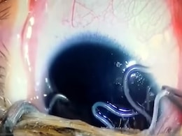 महिला की आंखों में रेंग रहे थे 60 जिंदा कीड़े, देख डॉक्टर भी रह गए हक्के बक्के, अगर आप भी करते हैं ऐसा तो.. महिला की आंखों में रेंग रहे थे 60 जिंदा कीड़े, देख डॉक्टर भी रह गए हक्के बक्के, अगर आप भी करते हैं ऐसा तो..