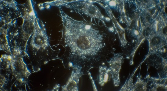Indigenous CAR-T Therapy Cures Patient Of Cancer: All You Need To Know