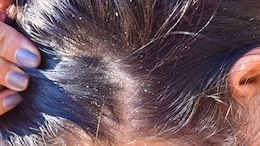 Experiencing Dandruff As The Weather Changes? Follow These Tips For Relief