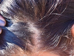 Experiencing Dandruff As The Weather Changes? Follow These Tips For Relief Experiencing Dandruff As The Weather Changes? Follow These Tips For Relief
