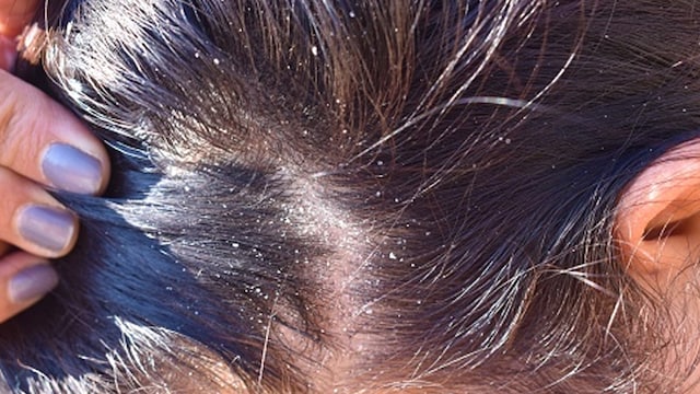 Salicylic acid exfoliates the scalp, removing dead skin cells and reducing flakes