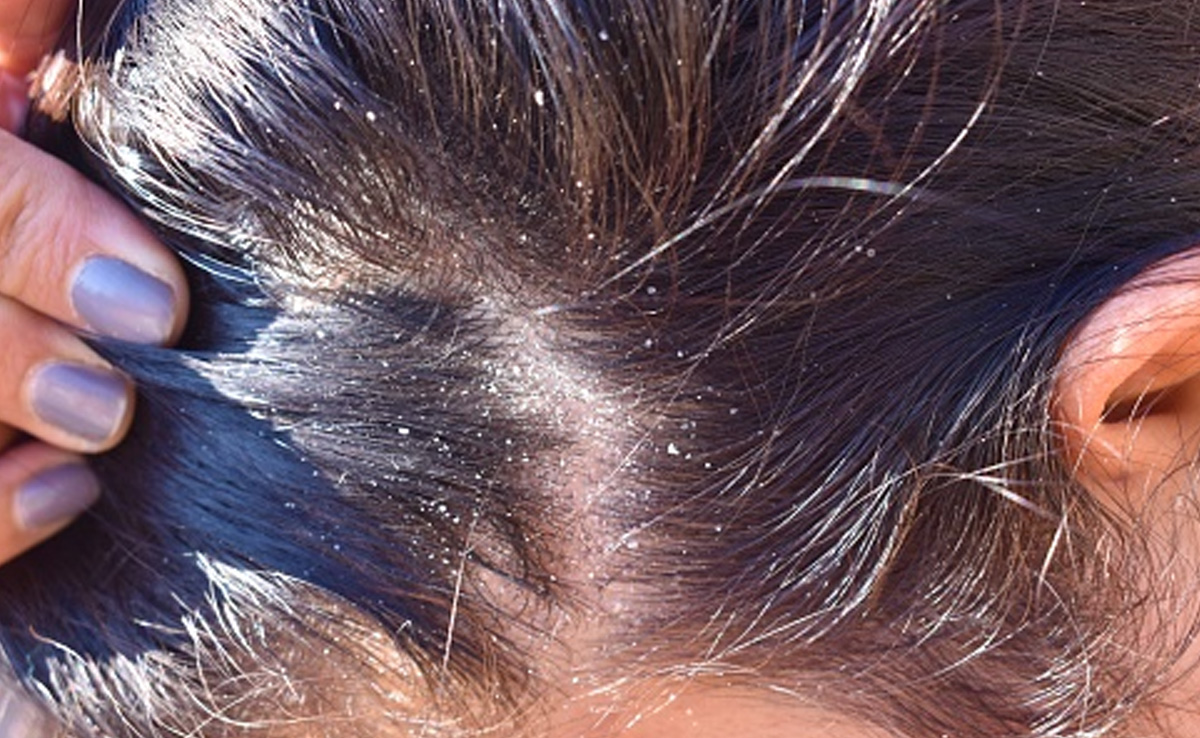 These tips help address dandruff from multiple angles, reducing dryness and irritation