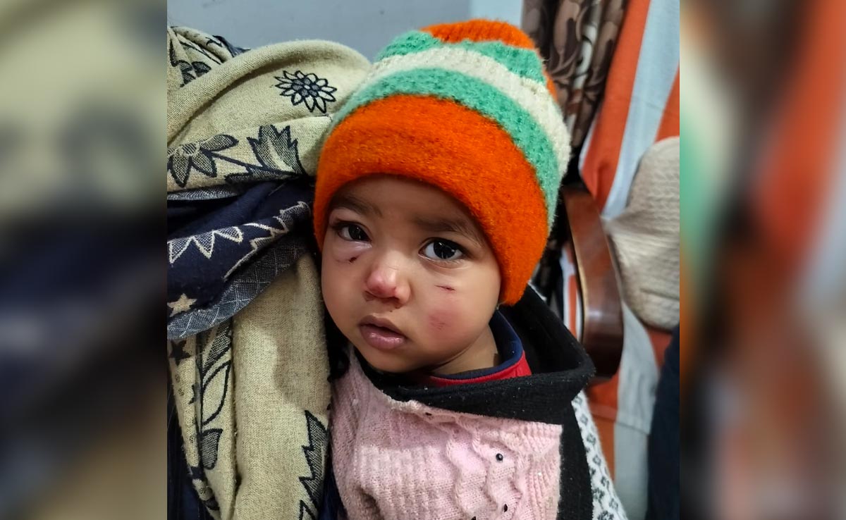 Chhatarpur: घर में सो रही मासूम बच्ची पर आवारा कुत्तों ने किया हमला, एक दिन में इतने लोगों को काटा&nbsp;
