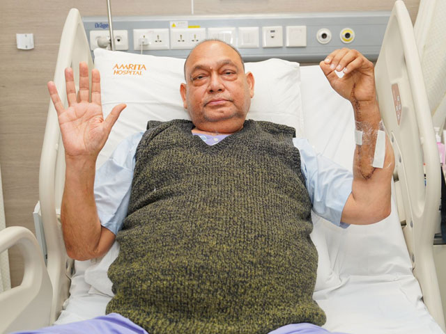 In A First, Hand Transplant Surgery Carried Out At Haryana Hospital