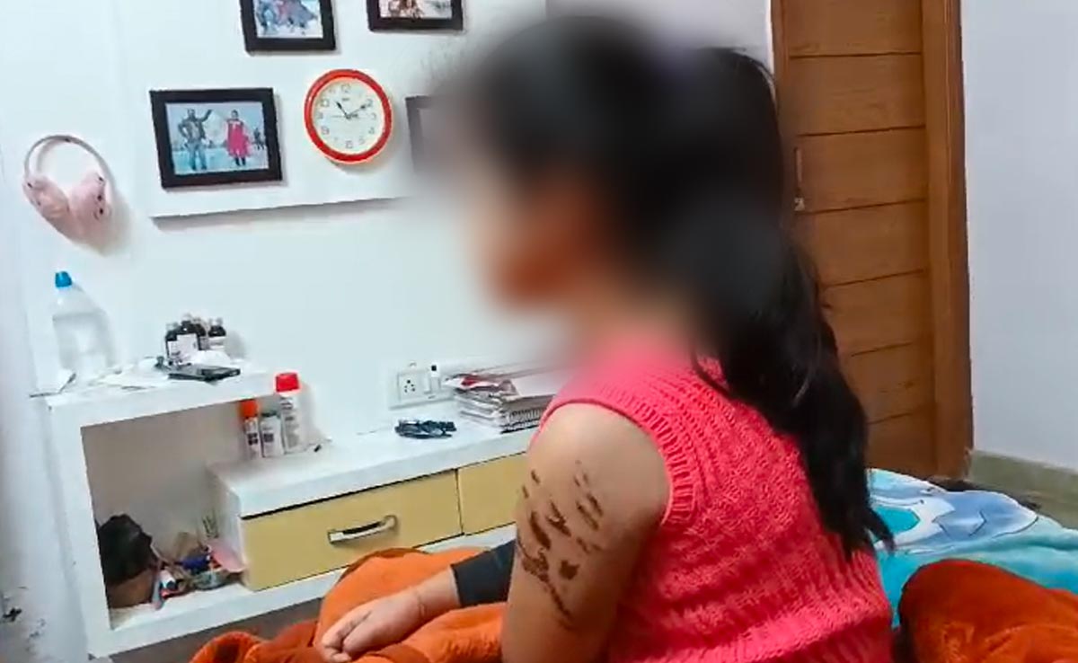 Girl, 7, Receives Over 15 Injuries After Being Attacked By American Bully Dog In Delhi