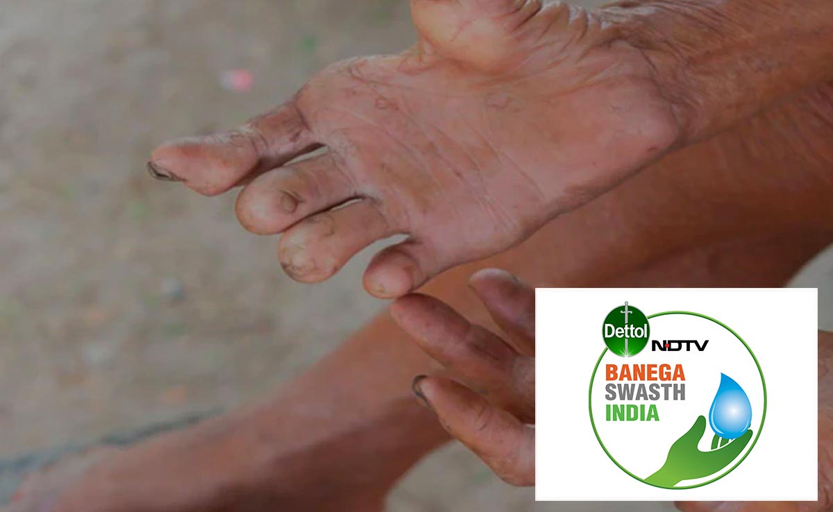 Watch: What Progress Has India Made In Eliminating Neglected Tropical Diseases?