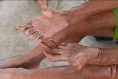 World Neglected Tropical Diseases Day: What Are These Diseases? World Neglected Tropical Diseases Day: What Are These Diseases?