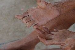 India's Fight Against Neglected Tropical Diseases India's Fight Against Neglected Tropical Diseases