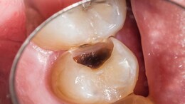 चॉकलेट से हो गई है बच्चों के दांतों में Cavity, इन टिप्स को अपनाकर करें दूर