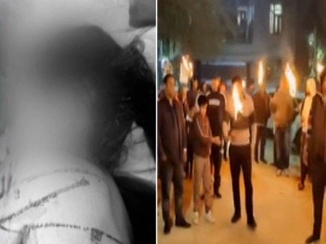 Girl, 7, Receives Over 15 Injuries After Being Attacked By American Bully Dog In Delhi