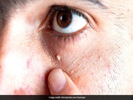 High Cholesterol: कॉलेस्ट्रोल बढ़ने के लक्षण इस तरह नजर आते हैं शरीर पर, आंखों और पैरों पर भी दिखते हैं निशान  High Cholesterol: कॉलेस्ट्रोल बढ़ने के लक्षण इस तरह नजर आते हैं शरीर पर, आंखों और पैरों पर भी दिखते हैं निशान