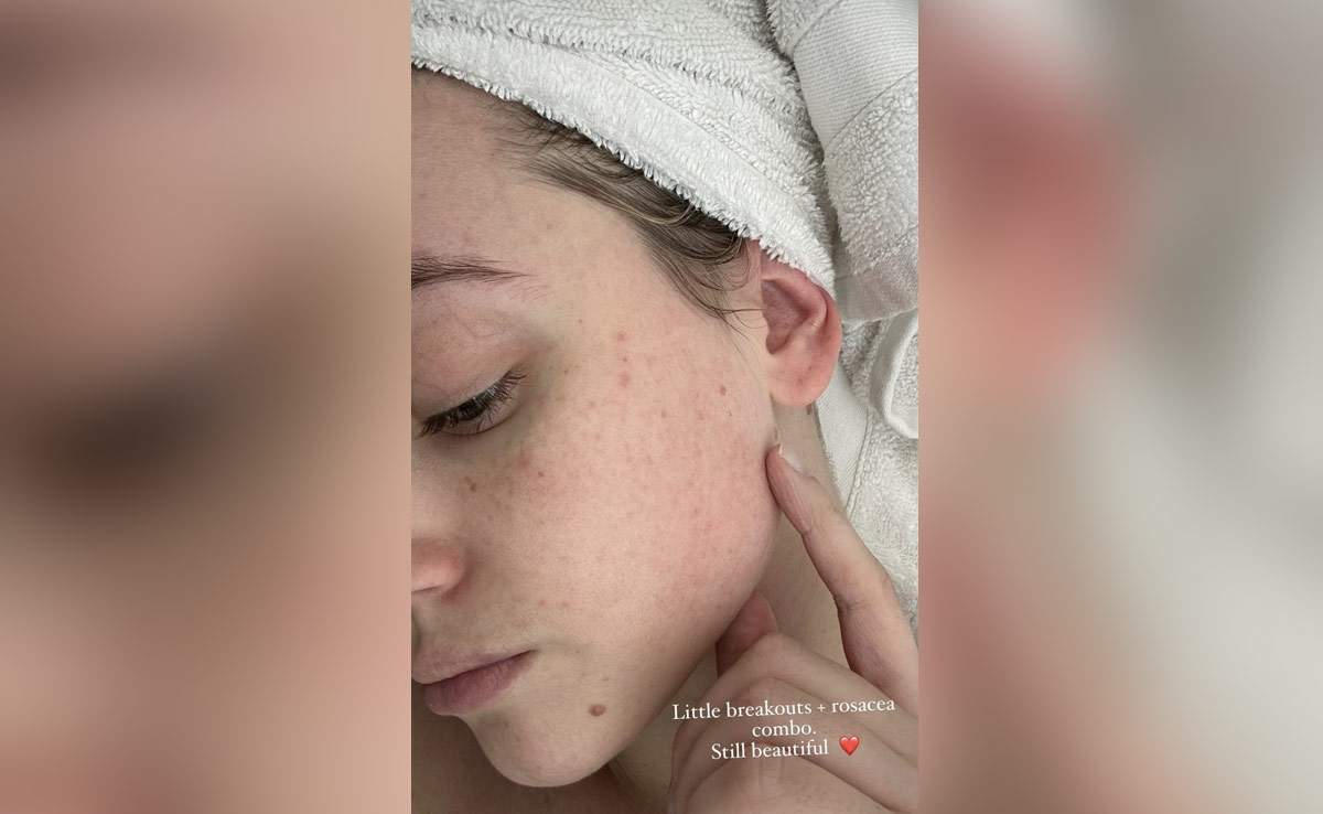 Lili Reinhart Owning Her Own Breakouts Is "Still Beautiful" And Embraces Imperfections In All Their Glory