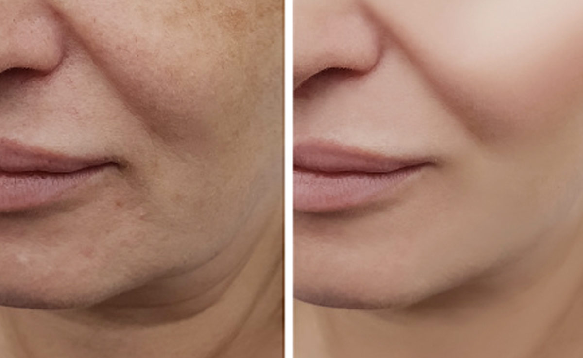 30 की उम्र में 50 की दिखने लगी हैं, चेहरे पर काले धब्बे, झाइयों और झुर्रियों से कम हो रहा है कॉन्फिडेंस, जानें चेहरे की झाइयों को कैसे खत्म करें?