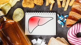 Best And Worst Foods For Fatty Liver Disease