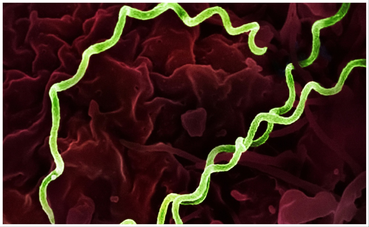 ''Syphilis Epidemic'': Cases Of Sexually Transmitted Disease Shoot Up In US