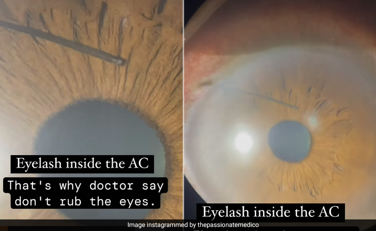 टूटकर आंख की पुतली में घुस गई पलक, वायरल वीडियो देख लोगों की निकली चीखें, जान लें क्यों आंख में कुछ गिरने पर मसलना नहीं चाहिए