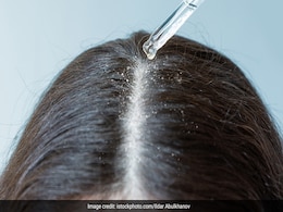 रूसी से पाना है छुटकारा तो नारियल तेल में इस एक चीज को मिलाकर लगा लीजिए सिर पर, डैंड्रफ भाग जाएगा रूसी से पाना है छुटकारा तो नारियल तेल में इस एक चीज को मिलाकर लगा लीजिए सिर पर, डैंड्रफ भाग जाएगा