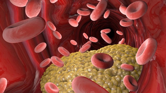 Blood thinners help by preventing platelets from clumping together and forming clots