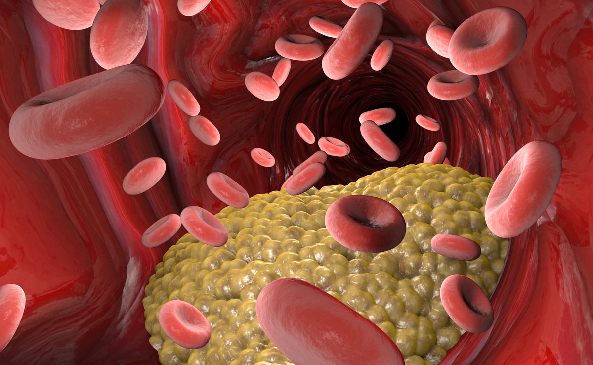 Blood thinners help by preventing platelets from clumping together and forming clots