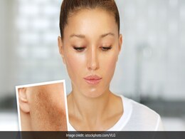 Hyper Pigmentation Treatment: हाइपर पिगमेंटेशन को दूर करना हुआ अब बहुत आसान, ये कॉस्मेटिक मैथड आएंगे काम Hyper Pigmentation Treatment: हाइपर पिगमेंटेशन को दूर करना हुआ अब बहुत आसान, ये कॉस्मेटिक मैथड आएंगे काम