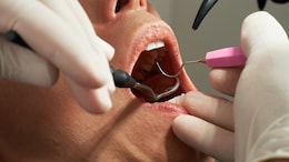 Kerala Dentist Ordered To Pay Rs 2 Lakh For Damaging Patient's Five Teeth
