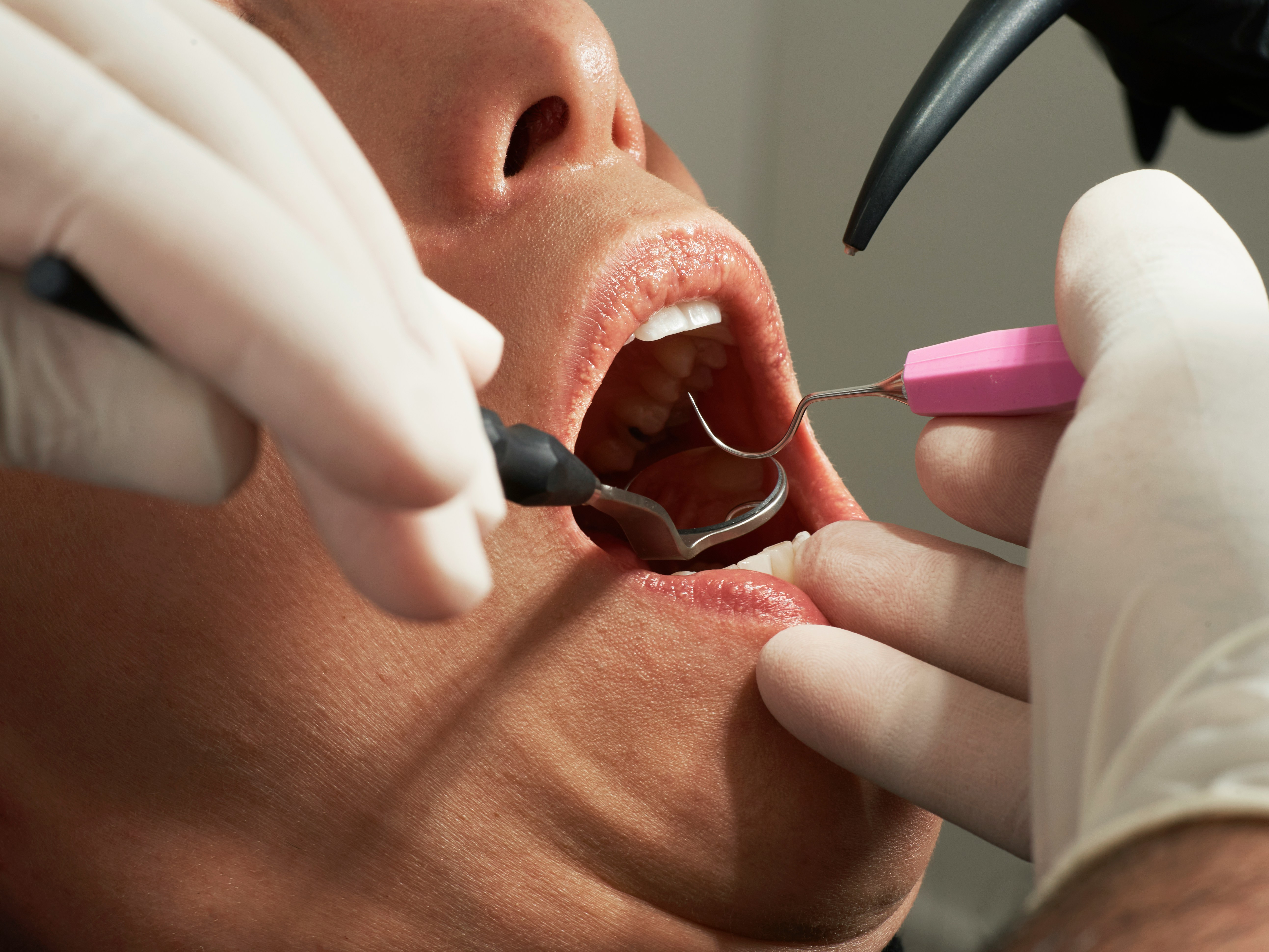 Methemoglobinemia affects how red blood cells provide oxygen to cells and tissues