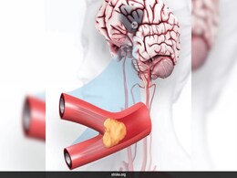 Stroke: Symptoms, Causes And Other Things About Brain's Equivalent Of Heart Attack Stroke: Symptoms, Causes And Other Things About Brain's Equivalent Of Heart Attack