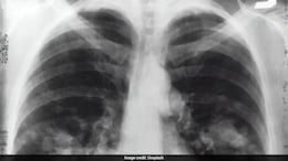 Lungs: 10 Most Common Causes For Pulmonary Embolism