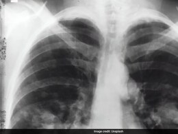Lungs: 10 Most Common Causes For Pulmonary Embolism