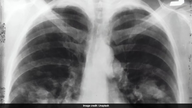 Smoking damages blood vessels and increases clotting factors, raising the risk of PE