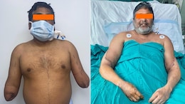 देश में ऐसा पहली बार: पुरुष की बॉडी में सर्जरी कर लगाए महिला के हाथ, पेंटर को मिली नई जिंदगी