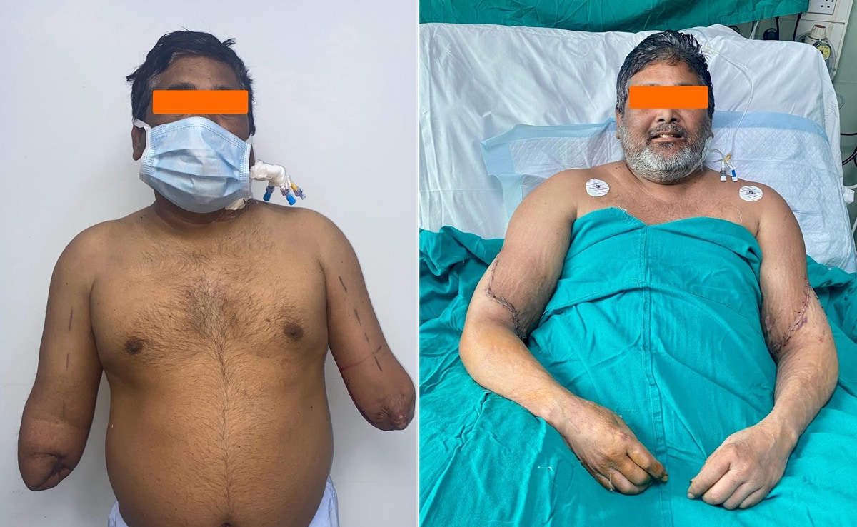 करिश्मा मेडिकल साइंस का : डॉक्टरों ने किया कमाल, दिल्ली के पेंटर को मिले नए 'हाथ'