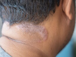 बाल की रूसी के कारण सफेद रंग के पैचेज हो रहे हैं माथे और गर्दन पर, तो इन घरेलू नुस्खों से करिए ठीक बाल की रूसी के कारण सफेद रंग के पैचेज हो रहे हैं माथे और गर्दन पर, तो इन घरेलू नुस्खों से करिए ठीक