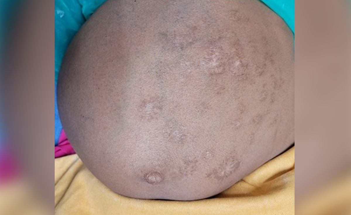 Health Myths: पेट दर्द होने पर झोलाछाप डॉक्टर ने दागे गर्म लोहे के छल्ले, Bhopal AIIMS की जांच में निकली यह बीमारी