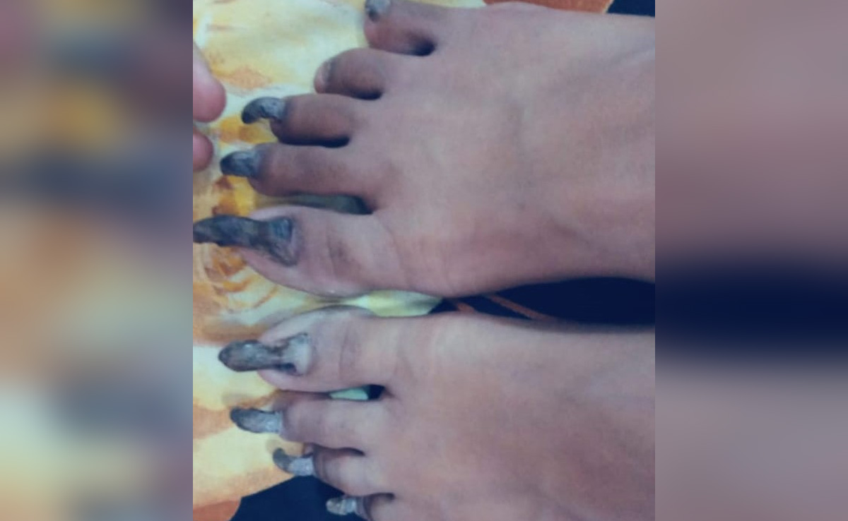 Rajasthan: आरी से भी नहीं कटते इस बच्ची के नाखून, AIIMS के डॉक्टर्स को भी करने पड़े कई प्रयोग