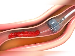 Angioplasty : पुण्याच्या वैद्यकीय क्षेत्रात क्रांतिकारी पाऊल, पहिल्यांदाच लेझर-असिस्टेड अन् स्टेंटशिवाय अँजिओप्लास्टी यशस्वी Angioplasty : पुण्याच्या वैद्यकीय क्षेत्रात क्रांतिकारी पाऊल, पहिल्यांदाच लेझर-असिस्टेड अन् स्टेंटशिवाय अँजिओप्लास्टी यशस्वी