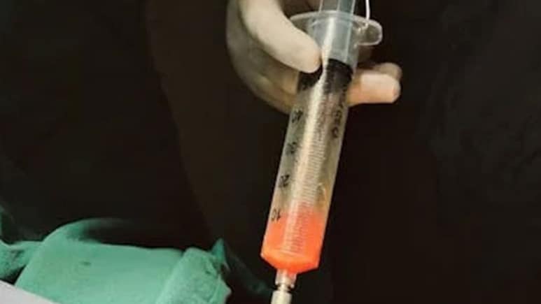 New AI Tool Can Predict Blood Loss With Accuracy During Liposuction