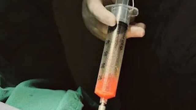 New AI Tool Can Predict Blood Loss With Accuracy During Liposuction