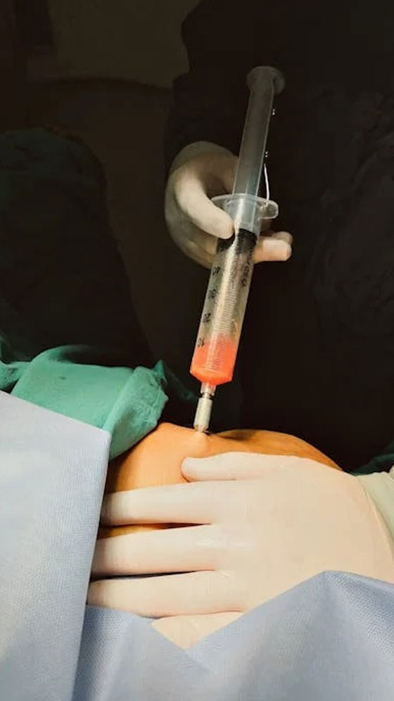 New AI Tool Can Predict Blood Loss With Accuracy During Liposuction