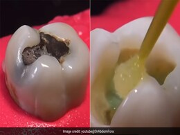 Dentist कैसे करते हैं रूट कैनाल ट्रीटमेंट? वायरल वीडियो देख उड़ जाएंगे होश, आप भी कहेंगे- डेंटिस्ट तो आर्टिस्ट निकले Dentist कैसे करते हैं रूट कैनाल ट्रीटमेंट? वायरल वीडियो देख उड़ जाएंगे होश, आप भी कहेंगे- डेंटिस्ट तो आर्टिस्ट निकले
