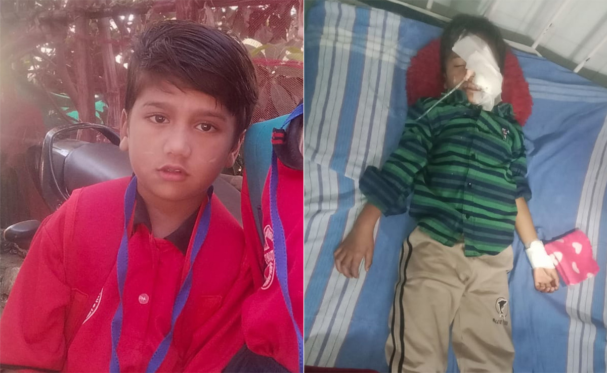 Bhopal: कुत्तों ने नोच डाला मासूम का चेहरा, पिता बोले- मेरे बच्चे का पूरा चेहरा खराब हो गया, नगर निगम...