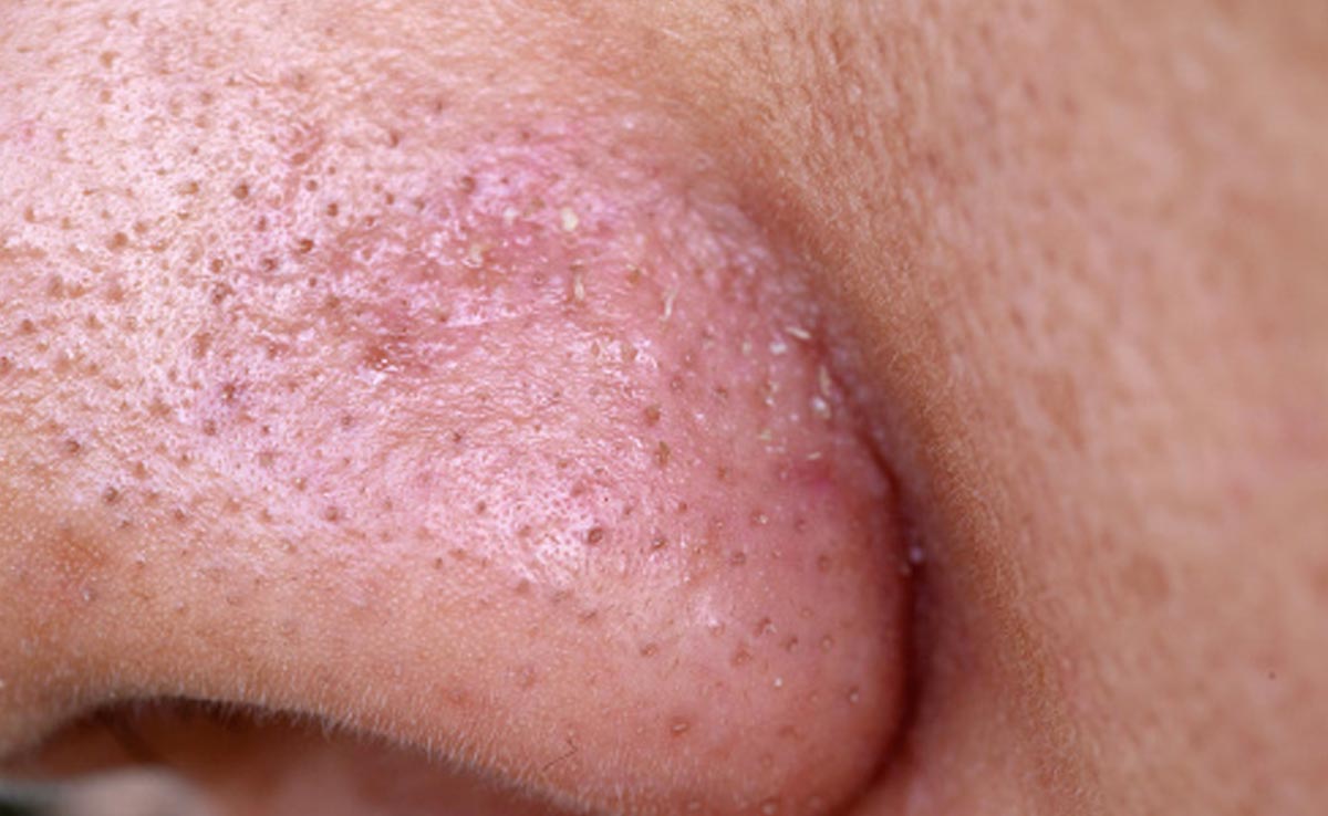 चेहरे पर दिखने वाले वाइटहेड्स को दूर कर देंगी घर की ये 5 चीजें, Whiteheads का नामोंनिशान भी नहीं आएगा नजर 