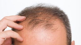 What Is Maharashtra's New Baldness Virus That Has Caused Sudden Hair Loss In Over 400 People?
