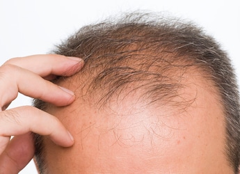 What Is Maharashtras New Baldness Virus That Has Caused Sudden Hair Loss In Over 400 People?