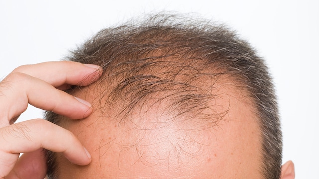 What Is Maharashtras New Baldness Virus That Has Caused Complete Hair Loss In Over 400 People