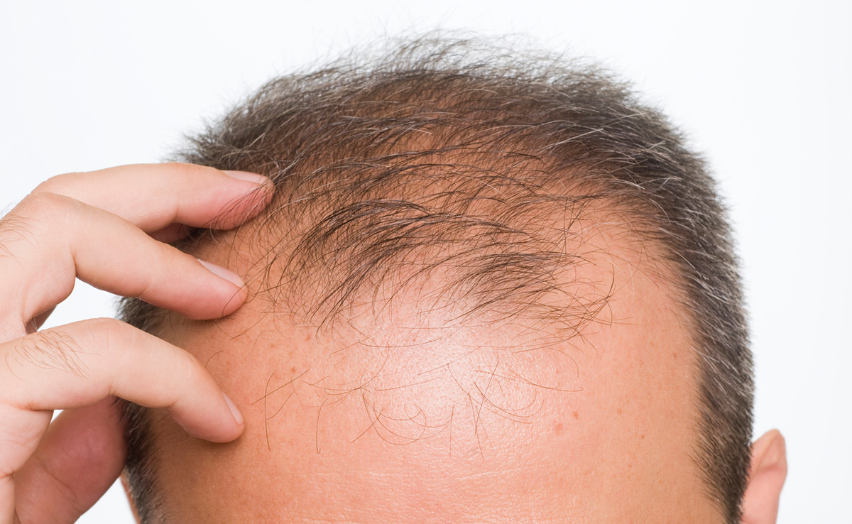 What Is Maharashtras New Baldness Virus That Has Caused Complete Hair Loss In Over 400 People